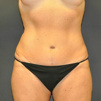 Abdominoplasty Before & After Patient 01