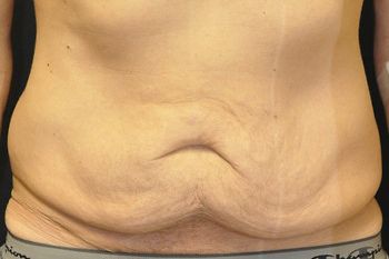 Abdominoplasty Before & After Patient 07