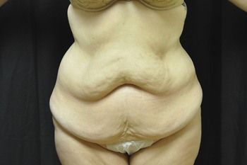 Abdominoplasty Before & After Patient 08