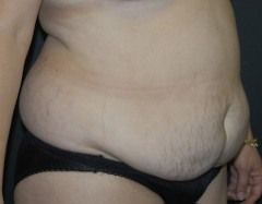 Abdominoplasty Before & After Photo Patient 09 Thumbnail