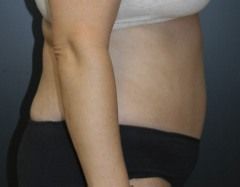 Abdominoplasty Before & After Patient 09