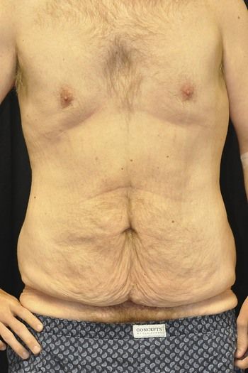 Abdominoplasty Before & After Photo Patient 10 Thumbnail