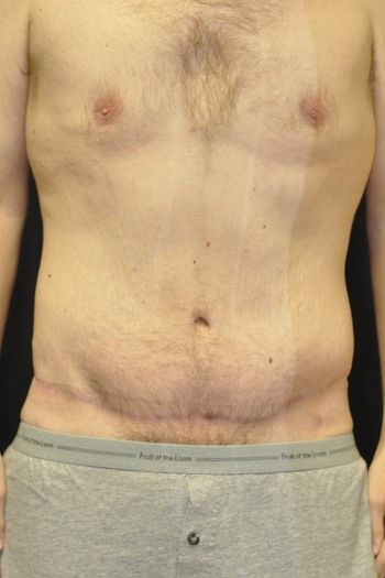 Abdominoplasty Before & After Patient 10