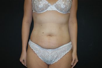 Abdominoplasty Before & After Patient 11