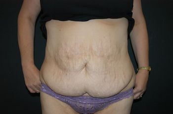 Abdominoplasty Before & After Patient 12