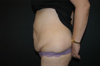 Abdominoplasty Before & After Photo Patient 12 Thumbnail