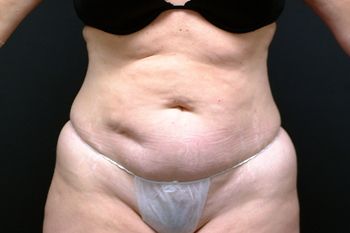 Abdominoplasty Before & After Patient 13