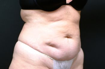 Abdominoplasty Before & After Patient 13