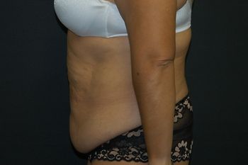 Abdominoplasty Before & After Patient 14