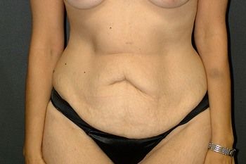 Abdominoplasty Before & After Patient 15