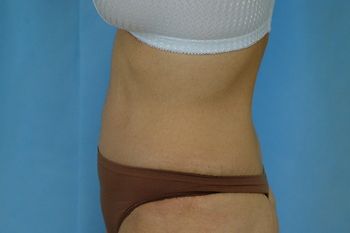 Abdominoplasty Before & After Patient 16