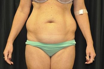 Abdominoplasty Before & After Patient 22
