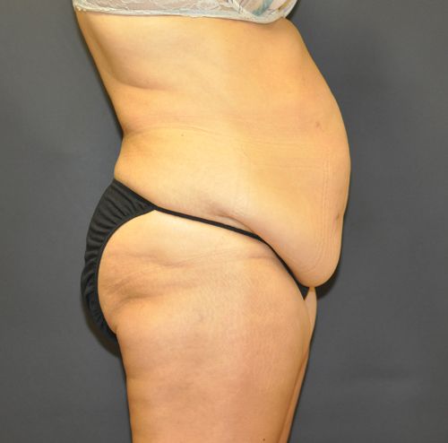 Abdominoplasty Before & After Patient 23