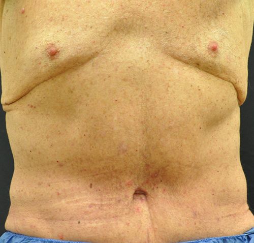 Abdominoplasty Before & After Patient 25