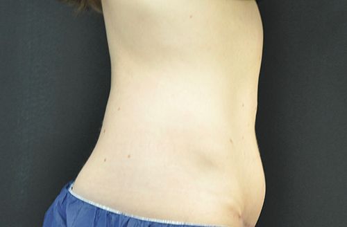 Coolsculpting Before & After Photo Patient 02 Thumbnail