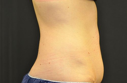 Coolsculpting Before & After Patient 02