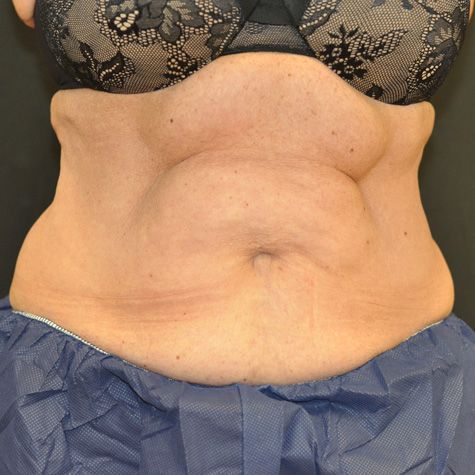 Coolsculpting Before & After Patient 03
