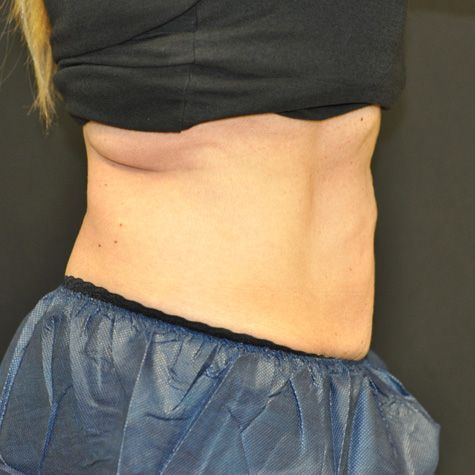 Coolsculpting Before & After Patient 03