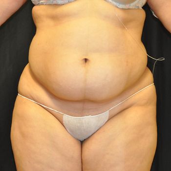 Liposuction Before & After Photo Patient 01 Thumbnail