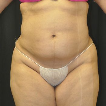 Liposuction Before & After Photo Patient 01 Thumbnail