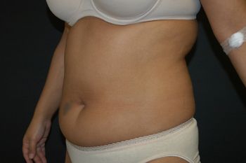 Liposuction Before & After Patient 03
