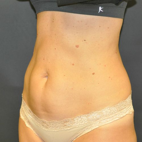 Sculpsure Before & After Photo Patient 01 Thumbnail