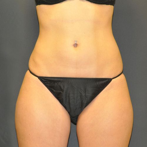 Sculpsure Before & After Patient 03