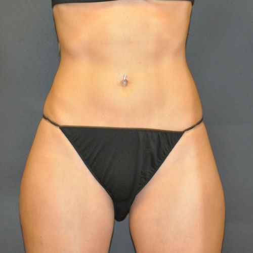 Sculpsure Before & After Patient 03