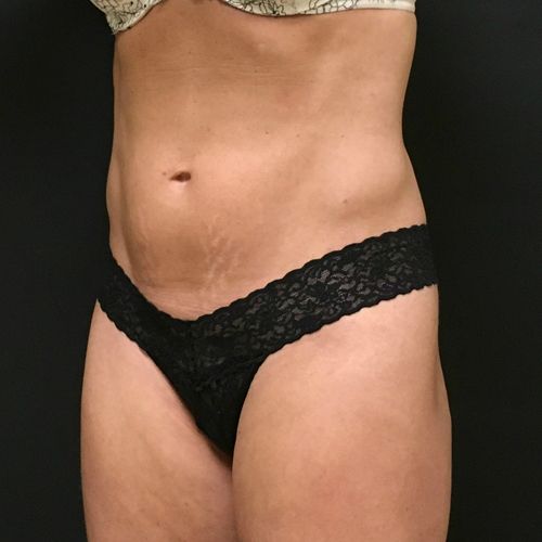 Sculpsure Before & After Photo Patient 04 Thumbnail