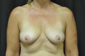 Breast Augmentation Before & After Patient 08