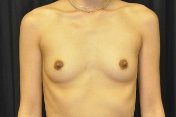 Breast Augmentation Before & After Patient 105