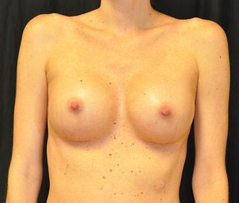 Breast Augmentation Before & After Patient 108