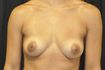 Breast Augmentation Before & After Patient 112