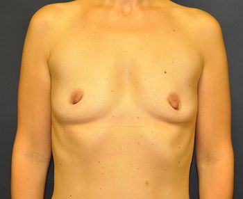 Breast Augmentation Before & After Patient 116