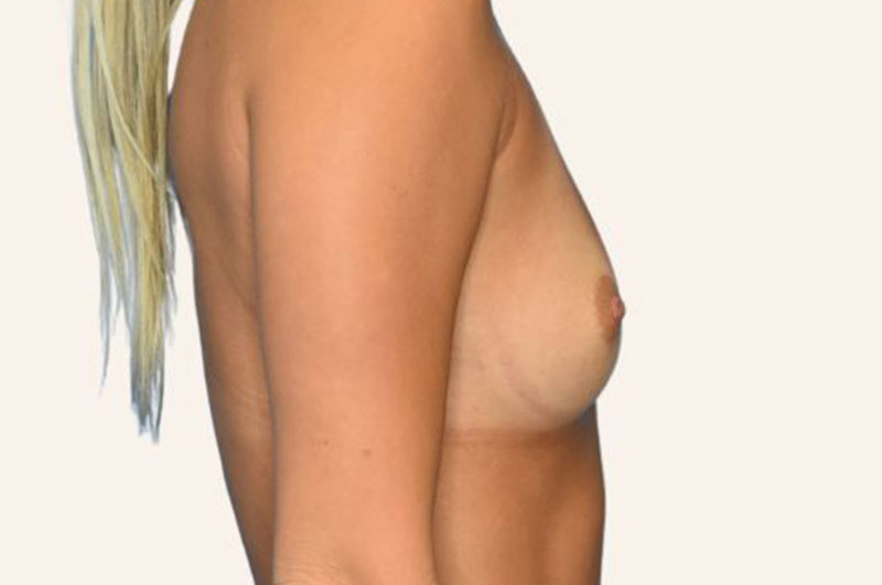 Breast Augmentation Before & After Patient 125
