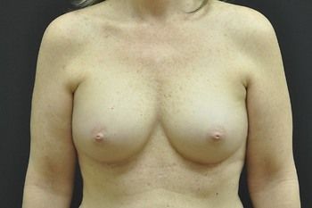 Breast Augmentation Before & After Patient 14