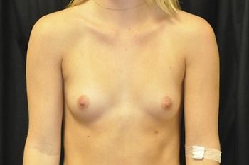 Breast Augmentation Before & After Patient 33