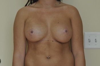 Breast Augmentation Before & After Patient 35