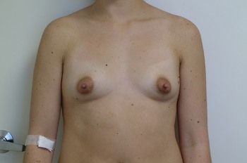 Breast Augmentation Before & After Patient 47