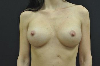 Breast Augmentation Before & After Patient 50