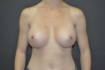 Breast Augmentation Before & After Patient 53