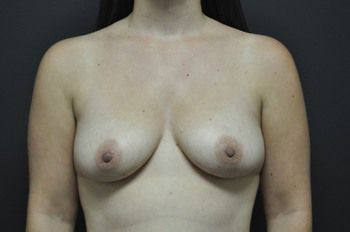 Breast Augmentation Before & After Patient 55