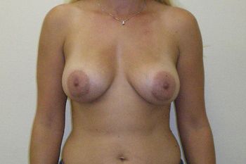 Breast Augmentation Before & After Patient 57