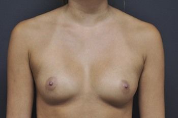 Breast Augmentation Before & After Patient 61