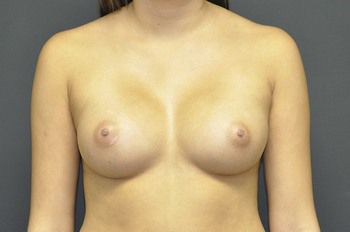 Breast Augmentation Before & After Patient 61