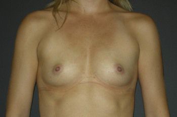 Breast Augmentation Before & After Patient 65