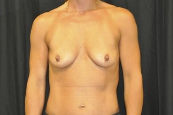 Breast Augmentation Before & After Patient 81