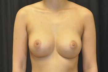 Breast Augmentation Before & After Patient 84