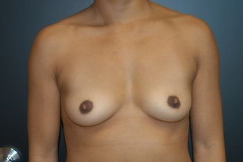 Breast Augmentation Before & After Patient 91