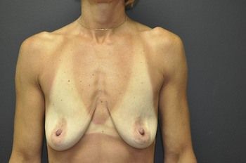 Breast Lift Before & After Patient 03